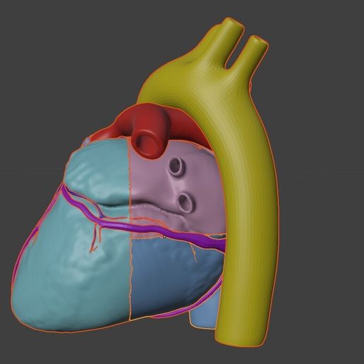 08.jpg 法洛氏四联症心脏 3D 模型