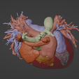 5.png 3D Model of Human Heart with Ventricular Septal Defect (VSD)