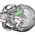 Captura-de-Pantalla-2023-08-22-a-la-s-6.40.01-p. m.png skull fracture / skull fracture