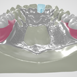 Kennedy-Class-I-Mod-1-Maxillary-4.png Prosthodontics Kennedy Class I Mod 1 Maxillary Removable partial denture (RPD)