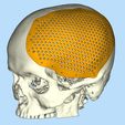 1.jpg cranial implant