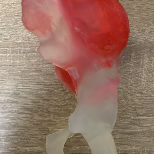 Preview6.jpg Sarcoma pélvico impreso en 3D