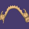 Clipboard-2024-06-11-20-38-10.jpg DIGITAL LOWER PARTIAL REMOVABLE DENTURE - flexible