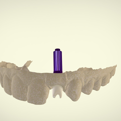 Screenshot_5.png STL file Digital Customized Abutment・Design to download and 3D print