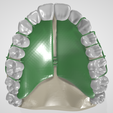 Removable-Palatal-Expansion-Appliance,-molar-distalizer,-teeth,-dental,-tooth,-palatal-expander,-app.png Aparato de Expansión Palatal Removible (KDE) en Dientes Superiores Aparato Dental