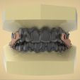 Snapshot_2017-8-30_2-55-22.jpg Digital Elastic Mandibular Advancement Appliance