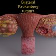 aa-0002.jpg Krukenberg ovarian cancer tumor