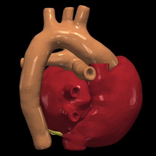 13.png 3D Model of Transposition of the Great Arteries Open Duct