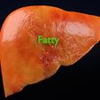 ps7-1.jpg 3D Alchoholic liver disease cirrhosis hepatitis fatty model