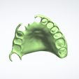 Clipboard-2024-05-06-10-46-24.jpg DIGITAL PARTIAL REMOVABLE DENTURES ( upper + lower + 3D MODELS !) - flexible