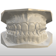 Screenshot_1.png Digital Full Coverage Occlusal Splint with Canine Guidance
