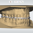Screenshot_20.png Digital Full Coverage Occlusal Splint with Canine Guidance