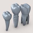 Dental-implant0003.jpg Dental Teeth & Implant Set – Stylized 3D Medical Model