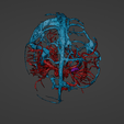 w10.png 3D Model of Brain Arteriovenous Malformation
