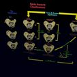 pelvis-fracture-classifications-3d-model-blend-33.jpg Pelvis fracture classifications 3D model