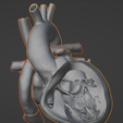 25.png 3D Model of Heart after Fontan Procedure