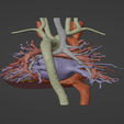 4.png 3D Model of Human Heart with Tetrology of Fallot (TOF) - generated from real patient