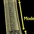 Image-0011.jpg Osteoporosis and its stages