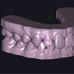 Pac-A-MAX-SUP-INF-Zocalado.png BOTH MAXILLARS - SUPERIOR and INFERIOR "ready for 3D printer" - AREA3D- Patient A. COMPLETE DENTURE