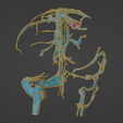 uv16.png 3D Model of Brain Arteriovenous Malformation