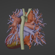2.png 3D Model of Human Heart with Anomalous Pulmonary Venous Drainage (APVC) - generated from real patient
