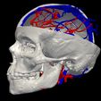 07.jpg 3D Model of Brain Arteriovenous Malformation