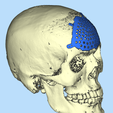 4.png CRANIAL PLATE MADE ACCORDING TO DEFECT