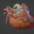 4.png 3D Model of Human Heart with Interrupted Aortic Arch (IAA) - generated from real patient