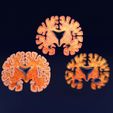 sig.jpg Alzheimer Disease Brain coronal slice