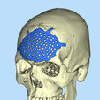 1.png CRANIAL PLATE MADE ACCORDING TO DEFECT