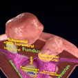 0018.jpg Fibroid Uterus Human female 3D