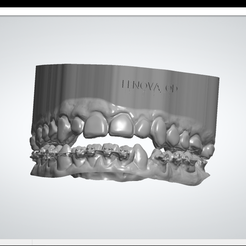 2 VAARPAA we @Pau> en 18q ees 3shape> Facets: 656409 Free STL file Orthodontic models・Design to download and 3D print