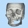 2.png Mandible implant-INDIVIDUAL PROSTHESIS FOR JAW RECONSTRUCTION
