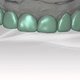 carillas-frontal.jpg lithium disilicate (rosetta) milled veneers tooth 1.1 1.2 1.3 2.1 2.2 2.2 2.3