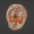 w2.png 3D Model of Middle Cerebral Artery (MCA) Aneurysm
