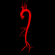 6.png 3D Model of Aorta and Aortic Vessel Tree - generated from real patient