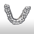 Screenshot_5.png Digital Full Coverage Occlusal Splint with Canine Guidance