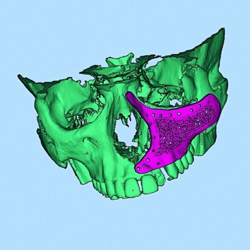 3d printed maxilla implants in facial rehabilitation - Cults3D 3D Model ...