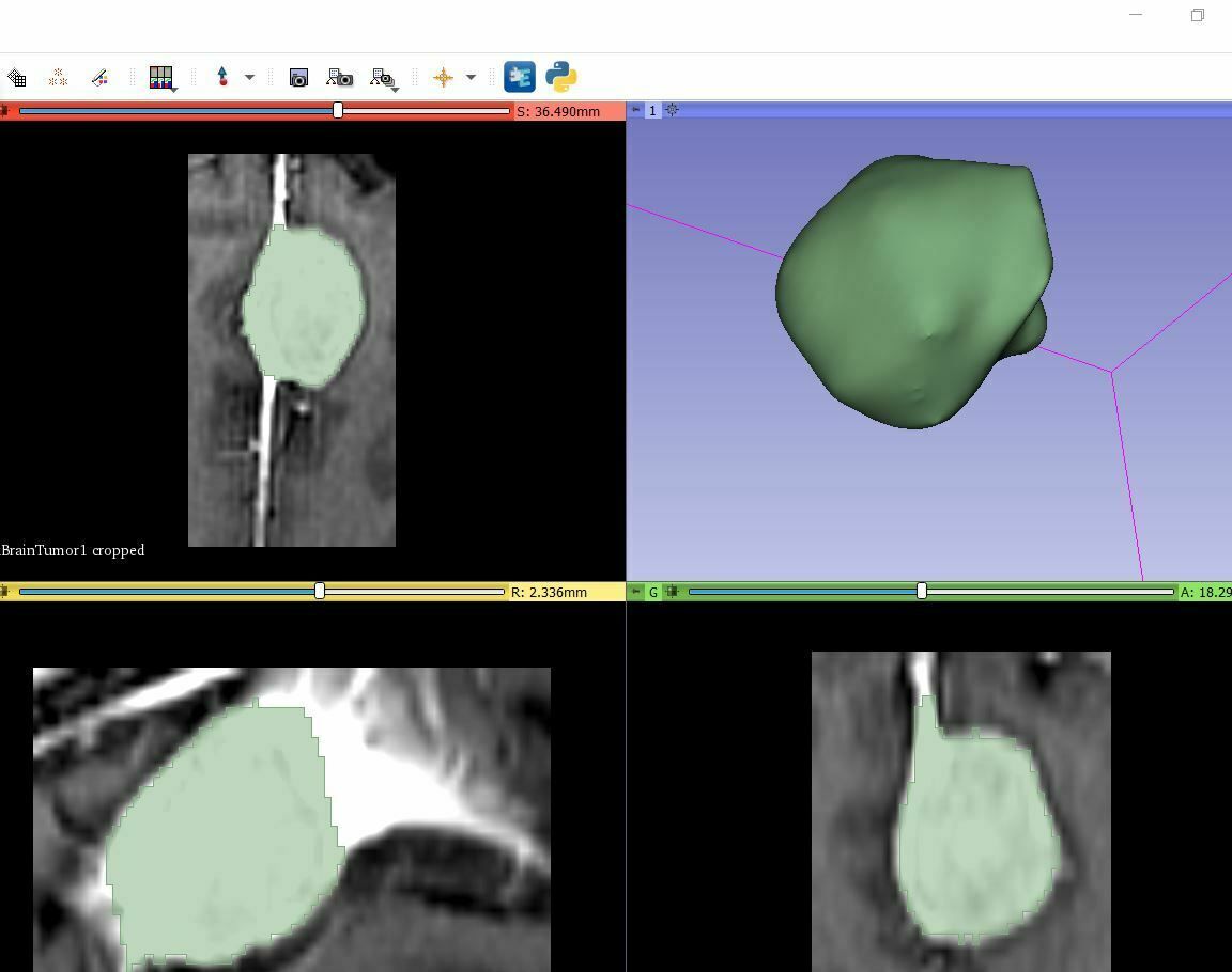 Download STL file 3D Brain Tumor • 3D printable object ・ Cults