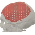 3.jpg CRANIAL PLATE MADE ACCORDING TO DEFECT
