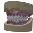 31.png Digital Full Dentures with Combined Glue-in Teeth Arch