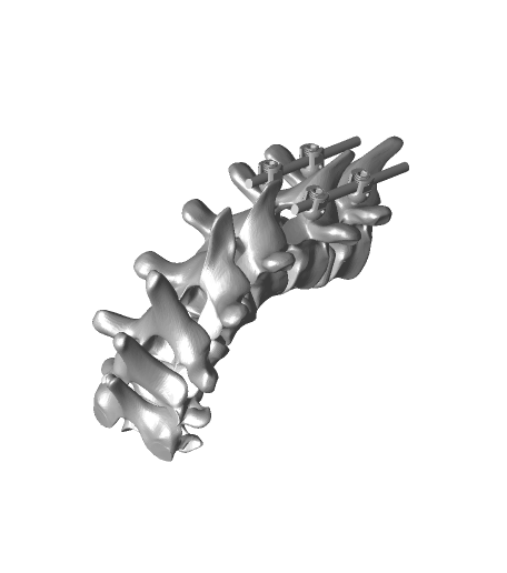 PJK_cervicothoracic_junction.png PJK zervikothorakaler Übergang Bennett-Putz