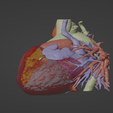 2.png 3D Model of Human Heart with Double Superior Vena Cava (DSVC) - generated from real patient