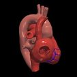 5.jpg 3D Model of Heart with Atrial Septal Defect