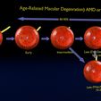 md1568.jpg Age-related macular degeneration AMD ARMD detailed labelled