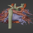 4.png 3D Model of Human Heart with Ventricular Septal Defect (VSD)