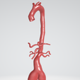 common-iliac-artery-aneurysm.png Case 1 to 6: 3D aortic and iliac artery aneurysm