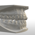 Screenshot_3.png Digital Full Coverage Occlusal Splint with Canine Guidance