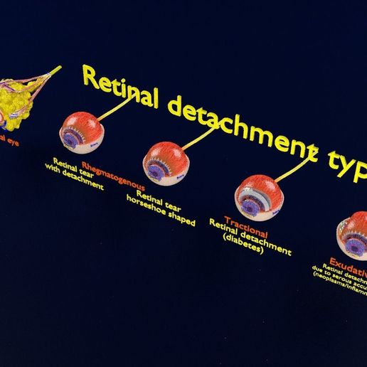 retinal-detachment-types-eye-3d-model-blend-67.jpg Retinal detachment types eye 3D model