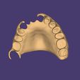 Clipboard-2024-06-11-20-24-50.jpg DIGITAL PARTIAL REMOVABLE DENTURES ( upper + lower + 3D MODELS !) - flexible